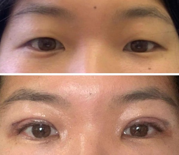 5. «Через 2 дня после блефаропластики. Веки сейчас отекшие, но даже так они нравятся мне больше».