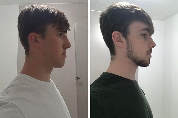 8. «8 недель после операции на челюсти».