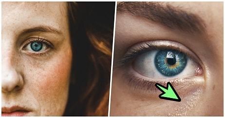 Gözlerinizin Çevresinde Oluşan Beyaz Noktaların Neden Oluştuğunu ve Tedavisini Açıklıyoruz!
