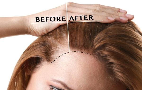 Kadın Saç Ekimi İyileşme ve Zaman Çizelgesi