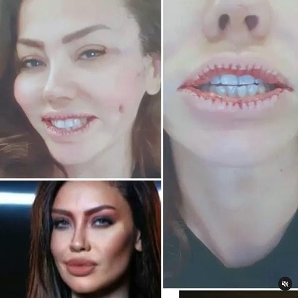 Instagram hesabından dudak küçültme ameliyatı geçirdiğini "Sonunda dudaklarım küçüldü" notuyla paylaştı. Şu an gördüğünüz fotoğrafta tam olarak 30 tane dikiş var. Düşününce bile insanın içi bir tuhaf oluyor.