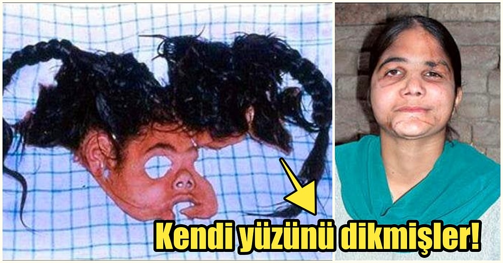 Bakmadan Geçmeyin! Modern Tıbbın Mucizesi Yüz Nakli Operasyonu Nasıl Gerçekleşir?