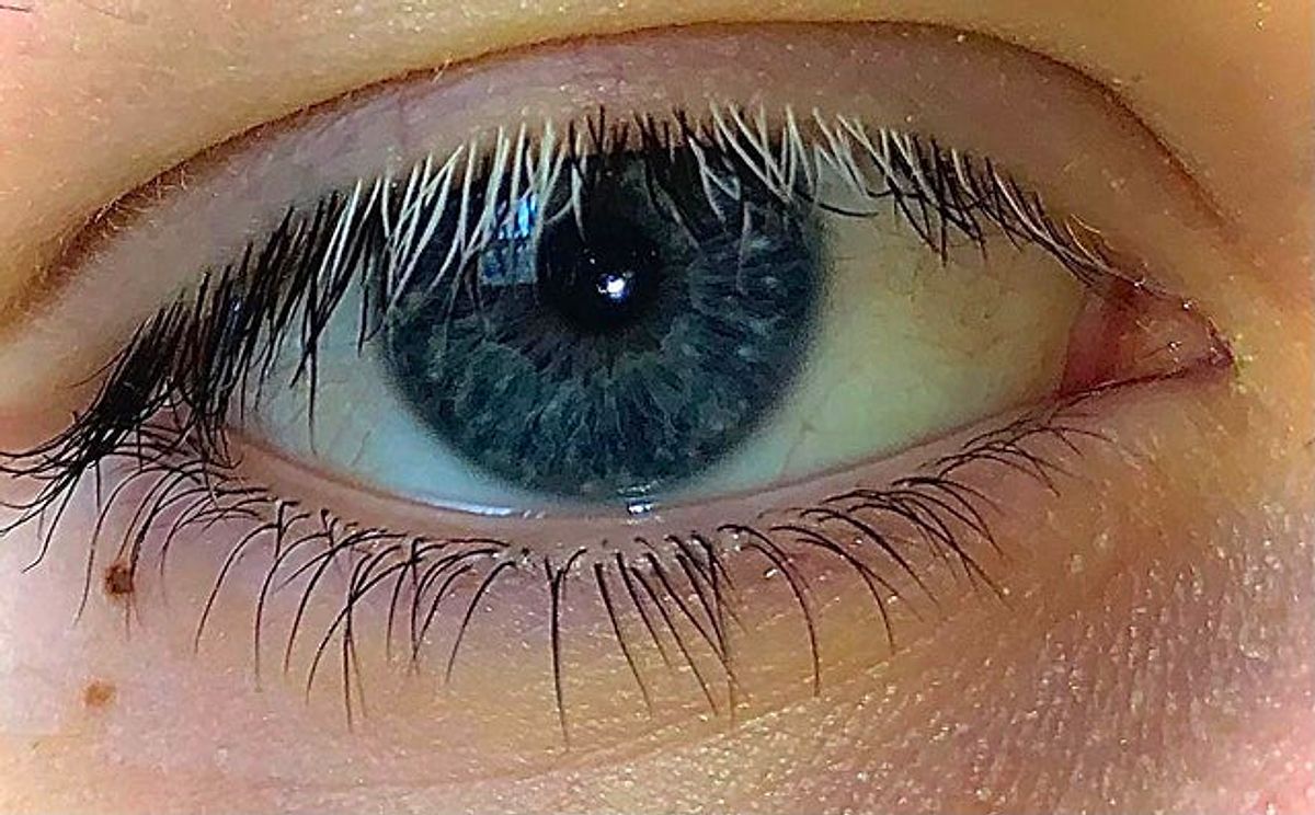 My right eye. Белые ресницы. Белые ресницы у человека на одном глазу. Трихотилломания ресницы. Ресницы стали белыми.