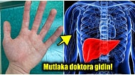 Aman Dikkat! Eğer Ellerinizde Bu Kızarıklıklar Varsa Karaciğerinizi Kontrol Ettirmeniz Gerekiyor Olabilir