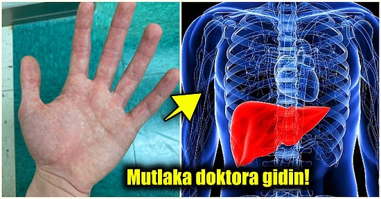 Aman Dikkat! Eğer Ellerinizde Bu Kızarıklıklar Varsa Karaciğerinizi Kontrol Ettirmeniz Gerekiyor Olabilir