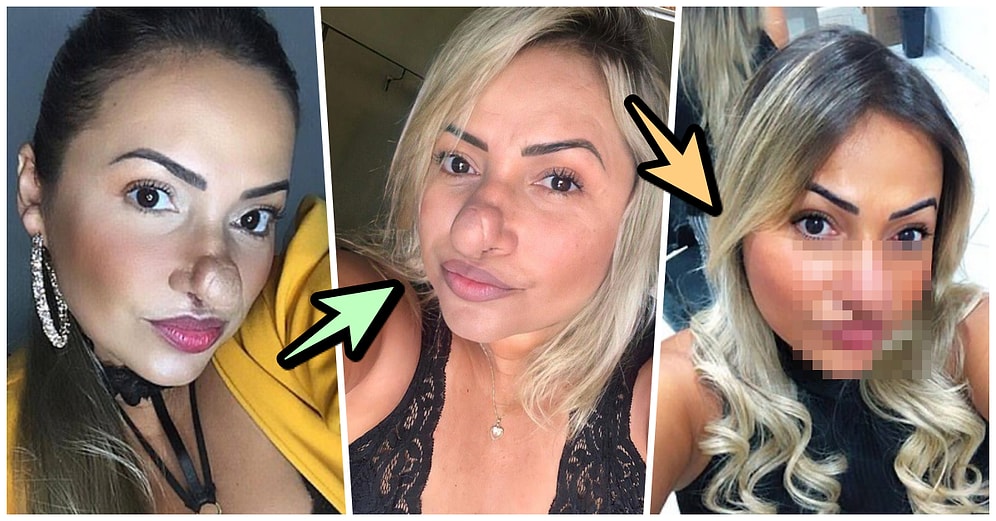 Burnundaki Tümörden Dolayı Hayatı Boyunca Kötü Yorumlara Maruz Kalan Kadının Bi' Garip Hikayesi