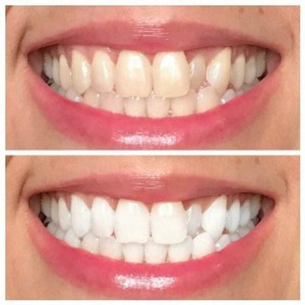 21. Kocaman gülümsemekten sararmış dişlerinizden dolayı çekiniyor musunuz?