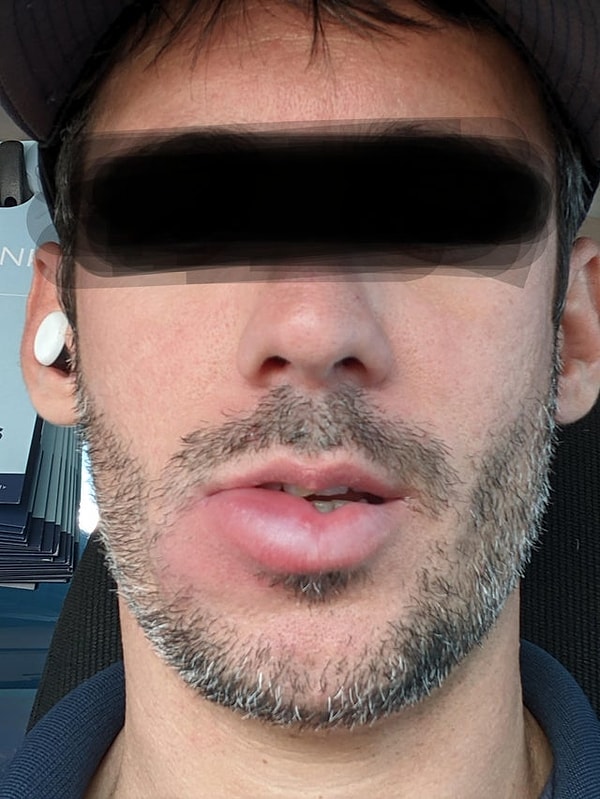 14. "Сразу три пчелы укусили мою губу!"