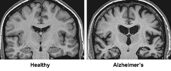 9. Alzheimer hastalığı sadece kademeli bir hafıza kaybı değildir. Fiziksel olarak da beyinde bulunur. Beyne saldıran fiziksel bir madde vardır. Mesela, Alzheimer hastalığından muzdarip bir kişinin kafatasını açıp baksaydınız, beyinlerinin  bu yapışkan, lifli, gri fiziksel madde tarafından ele geçirildiğini görürdünüz.