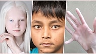 Vücutlarındaki Genetik Farklılıklarla Benzersizlikte Adeta Çığır Açan Birbirinden Özel 27 İnsan