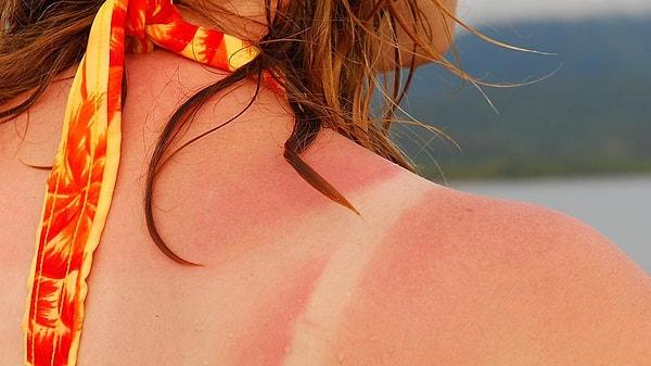Malum kavurucu yaz sıcakları baş gösterdi... Bu süreçte güneş kremi kullansak bile vücudumuzda çeşitli yanıklar oluşabiliyor.