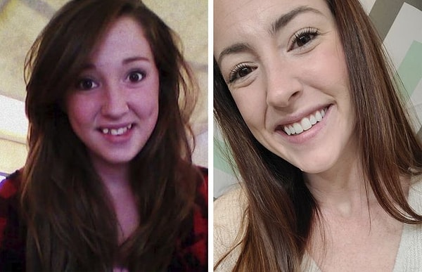 2. "Soldaki fotoğrafta 15, sağdakinde 27 yaşımdayım. Tel tedavisine şükranlarımı sunuyorum."