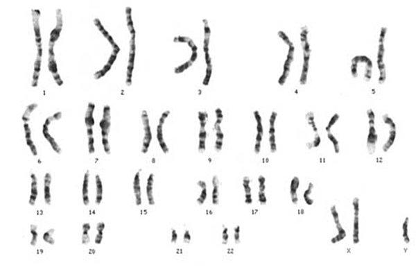 Klinefelter sendromu, erkeklerin fazladan bir kadınlık belirten X kromozomuna sahip olduğu genetik bir durum olarak tanımlanıyor.