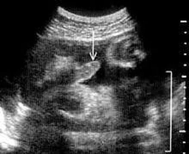 5. Penis ilk erektesini anne karnındayken yaşar.