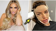Estetik İçin Türkiye'den Şaşmayan Katie Price Para Karşılığında Ameliyat Görüntülerini Sansürsüz İzlettiriyor!