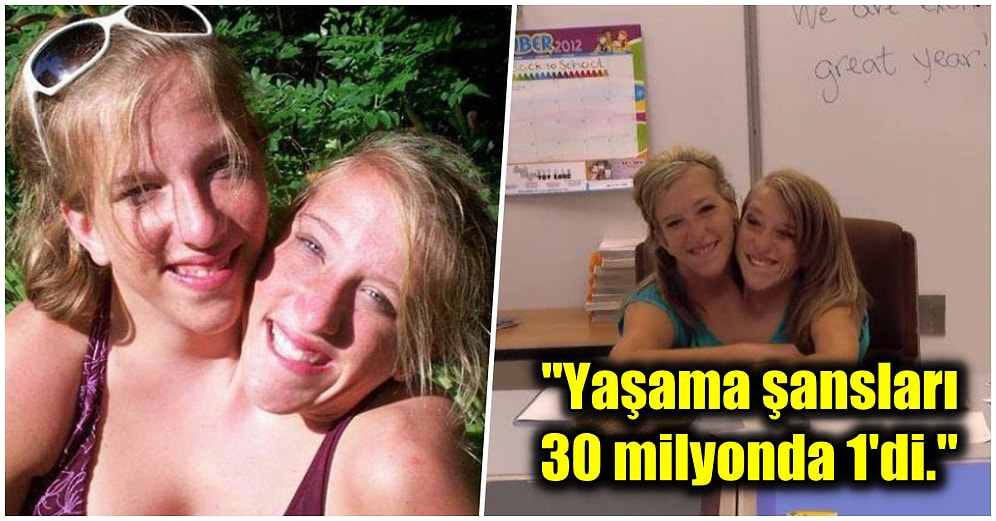 Doğumda Yaşama Şansları Oldukça Düşük Olmasına Rağmen Hayata Tutunup Öğretmen Olan Yapışık İkizler