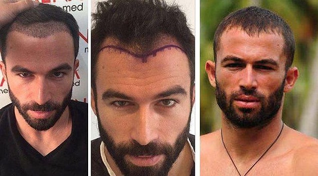 11. Mersin doğumlu 'Survivor' yıldızı Turabi protez saç yaptıran isimlerden.