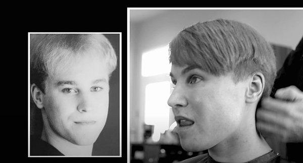 Bieber'ın kâküllerini ve saç çizgisinin aynını yakalamak için çeşitli saç ekimi uygulamaları yaptıran Toby, kaşlarının altı için dolgu operasyonu geçirmiş.