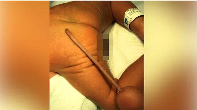 3. Brezilya'da bir bebeğin 12 cm kuyrukla dünyaya geldiği açıklandı. Sinir sistemine bağlı olmayan ve ucunda yuvarlak bir et parçasının bulunduğu kuyruk, cerrahi operasyonla alındı.