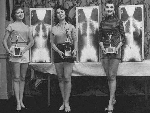 10. An orthopedics conference in Chicago, United States in the 1950s, where the best spine was chosen: