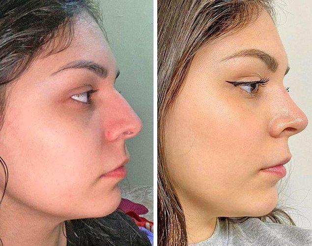7. "Before and almost 2 months after rhinoplasty"