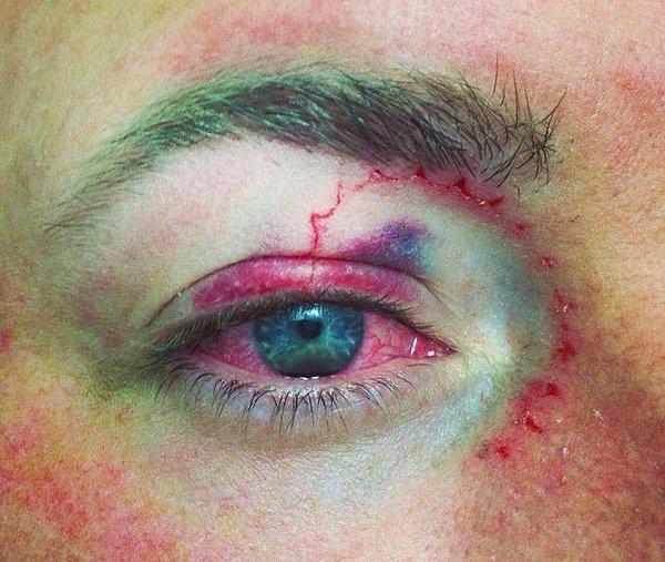 10. "Şişe kapağı göz yaralanması"