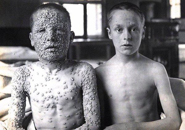 9. "Smallpox'a maruz kalan iki çocuk. Birisi aşılı, diğeri değil."