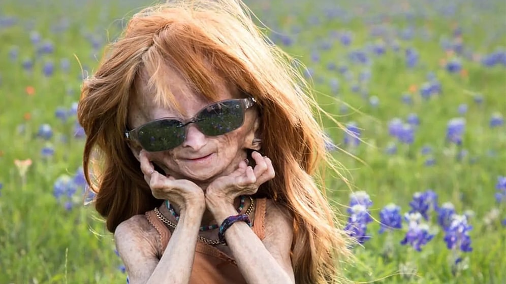 'Benjamin Button Hastalığı' ile Mücadele Ediyordu: YouTuber Adalia Rose Williams, 15 Yaşında Hayatını Kaybetti