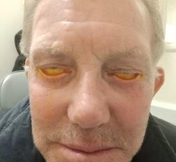 Fakat ameliyat sonrası sol gözü sürekli açık kalan Pete uyuyacağı zamanlarda gözünü kapatabilmek için bant kullanmaya başlamış.
