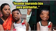 Yine Hindistan! Ameliyattan Sonra İki Burnu Olan Küçük Kız Tüm Ülkede İlgi Odağı Haline Geldi