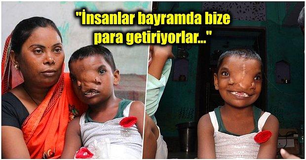 Yine Hindistan! Ameliyattan Sonra İki Burnu Olan Küçük Kız Tüm Ülkede İlgi Odağı Haline Geldi