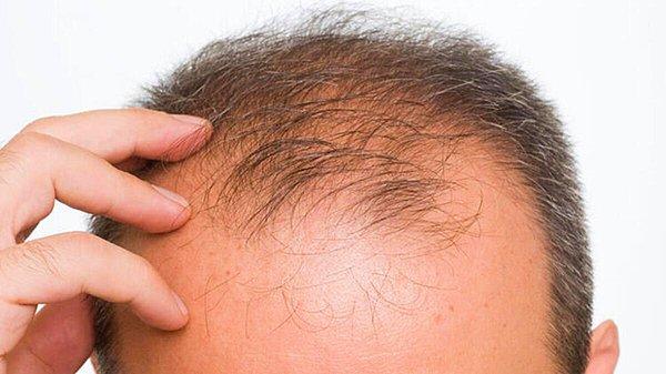 Saç dökülmesinin genetik olmasının yanı sıra farklı etkenler de dökülmeyi etkileyebilir.