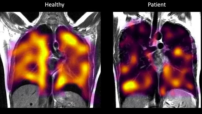 Yeni Tarama Yöntemi, Uzun Kovid Hastalarındaki Gizli Akciğer Hasarını Ortaya Çıkardı