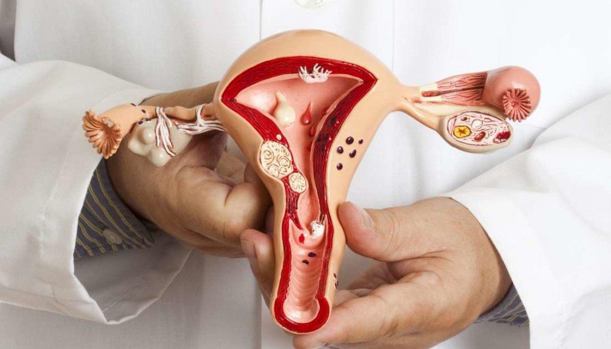 рак яичников у женщин фото