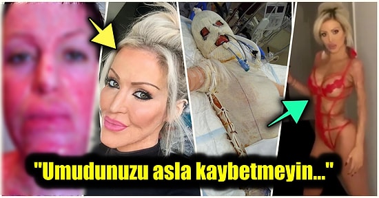 Kıskançlık Krizi Yüzünden İspirtoyla Tüm Vücudu Acımasızca Yakılan Kadının Yıllar Sonraki Muhteşem Değişimi