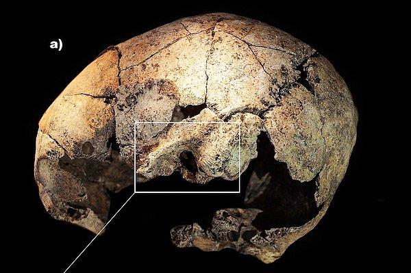 6. 5 bin 300 yıl önce İspanya'da kulak ameliyatı yapılmış!