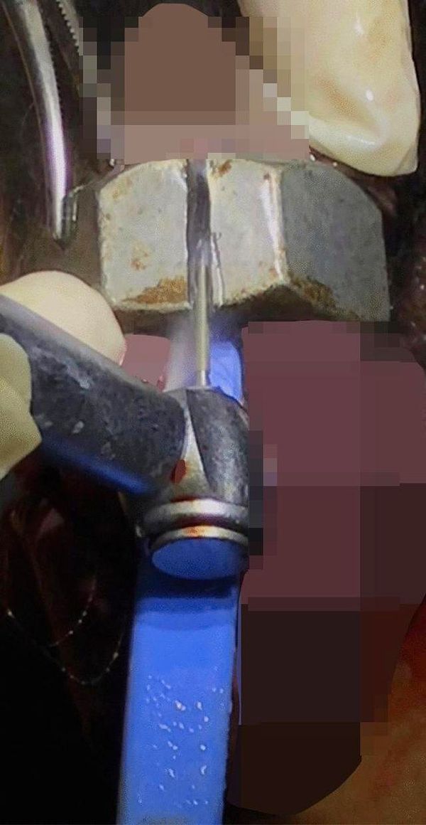 Doktorlar penis şiştiği için elleri ile müdahale edemediler ve diş matkabı ile halkayı kestiler.