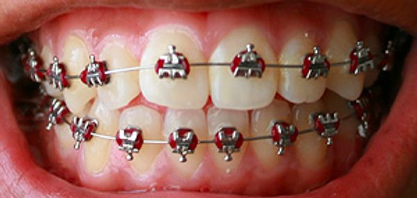3. Diş telleri için yaşınızın ilerlediğini düşünmek.