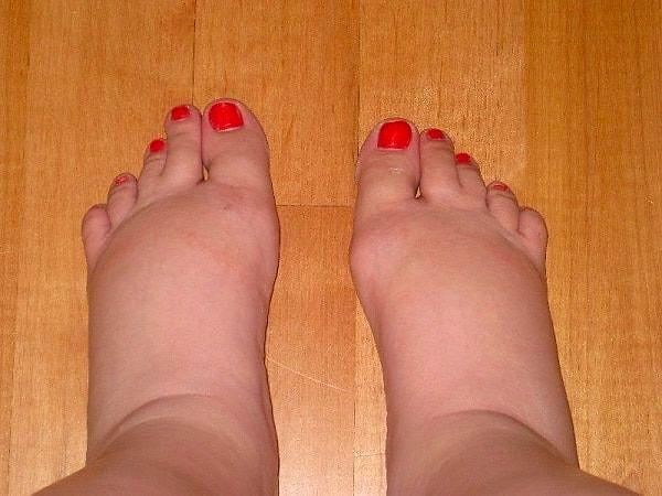 8. Ayak bileklerinize bastırınca çukurlar oluşuyor mu?