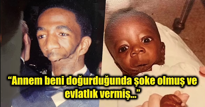 Çenesi Olmadığı İçin Konuşmakta, Yemek Yemekte ve Hatta Nefes Almakta Zorlanan Adamın Şaşırtıcı Hayat Hikayesi