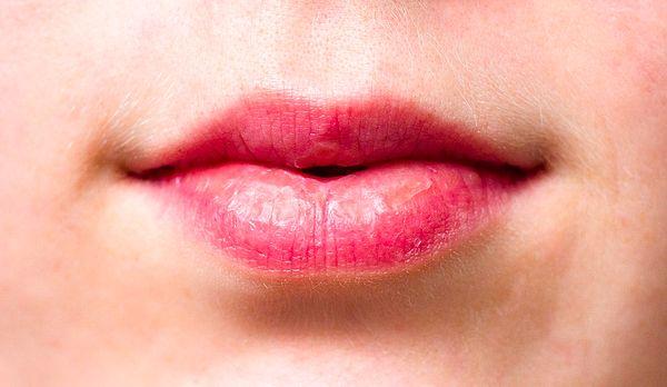 3. Çatlamış dudaklar