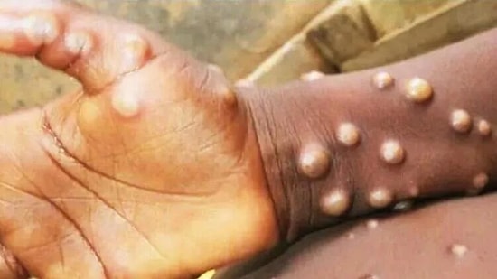 Bakan Koca, İstanbul'da Şüphe Üzerine Maymun Çiceği Testi Yapılan 4 Kişinin Sonuçlarını Paylaştı