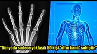 Sizi Eşsiz ve Küçük Bir Grubun Parçası Yapan Az Rastlanır Genetik Özellikler