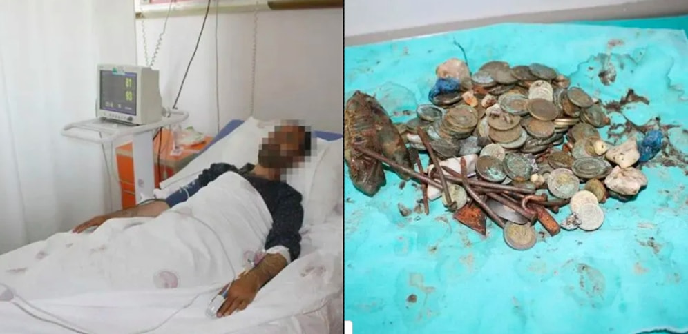 Midesinden 83 Tane Bir TL Çıktı