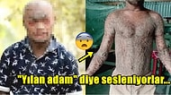 Dünyanın Sadece Yüzde 1'inde Görülen Nadir Hastalığı Sebebiyle Her Hafta Yılan Gibi Deri Değiştiren Adam