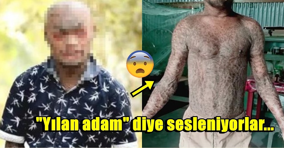 Dünyanın Sadece Yüzde 1'inde Görülen Nadir Hastalığı Sebebiyle Her Hafta Yılan Gibi Deri Değiştiren Adam