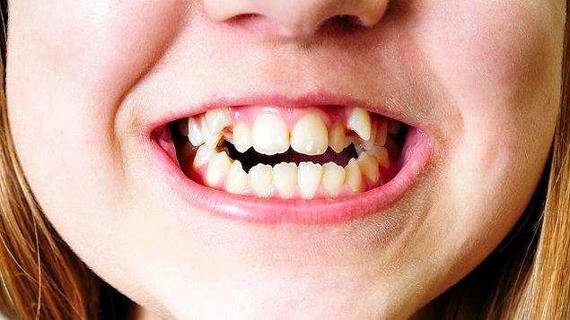 7. Diş şekli bozuklukları