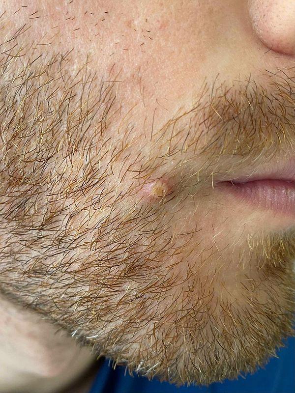 "CDC'ye göre, bir kişi ancak her lezyon kabuklanıp döküldükten ve altta taze, sağlıklı bir cilde sahip olduktan sonra tamamen iyileşmiş sayılır ve bulaşıcı olmuyor."