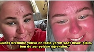 Güneşe Ateş Eden Adanalıların Anlayacağı Bir Hikaye: 1 Saat Güneşte Kaldıktan Sonra Yüzü Yanan Talihsiz Kadın