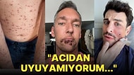 "Monkeypox" Yani Maymun Çiçeği Virüsünün Vehametini Gözler Önüne Seren Birbirinden Ürkütücü Kareler